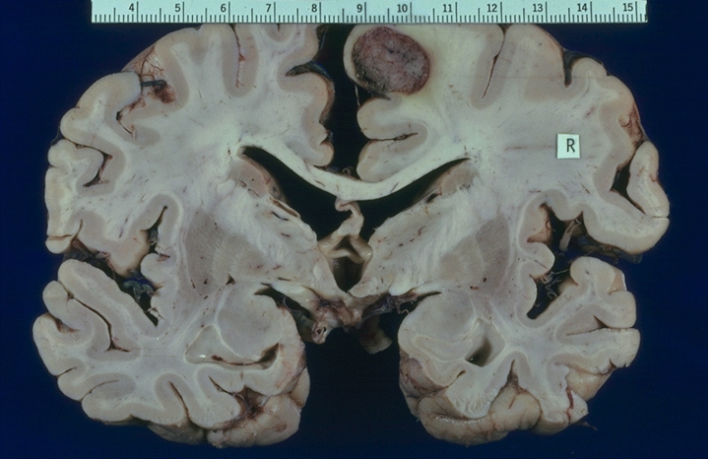 This solitary brain metastasis from thyroid papillary carcinoma resulted in neurological symptoms. The thyroid primary was clinically occult. (Courtesy of Dr. Nikola Kostich, Minneapolis, MN.).[3]