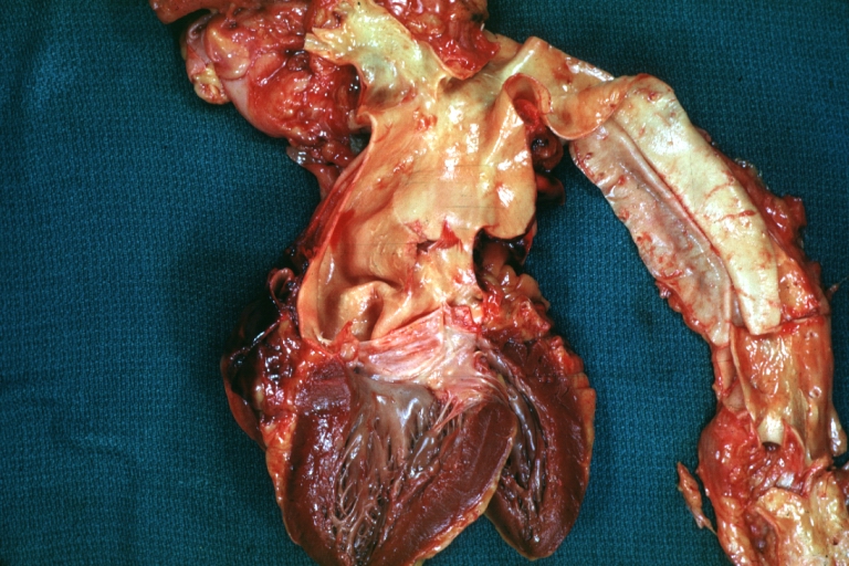 Dissecting Aneurysm: Gross shows origin just above aortic valve false channel shown in descending thoracic aorta (very good example)
