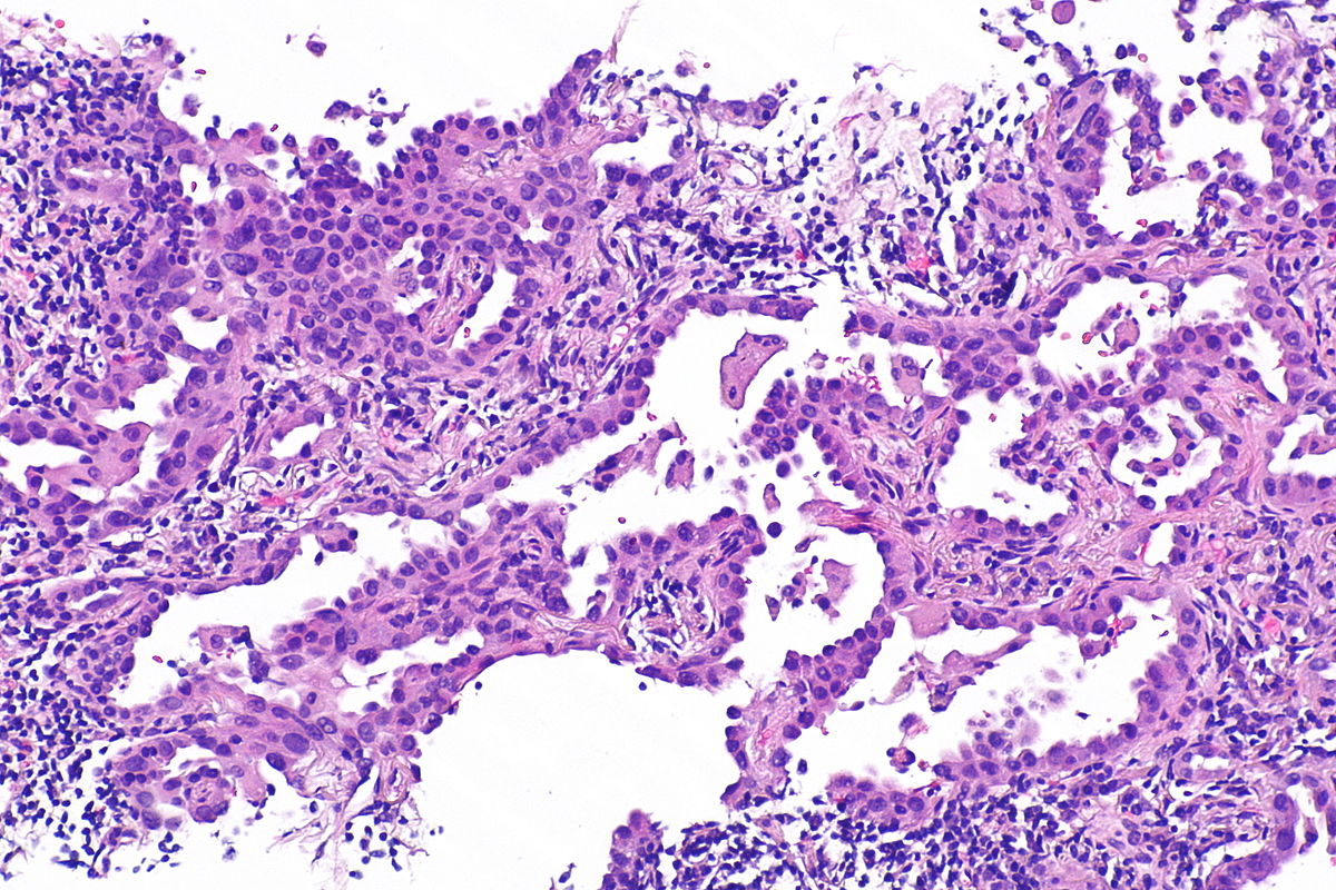 Micrograph of mucinous adenocarcinoma of the lung. H&E stain. [3]