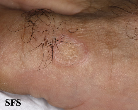 Porokeratosis of mibelli. With permission from Dermatology Atlas.[5]
