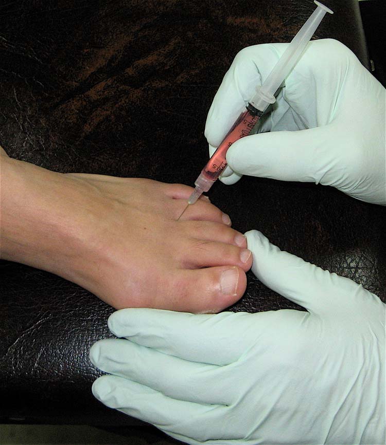 File:Prolotherapy.jpg