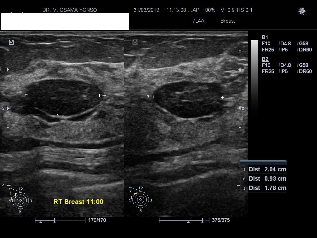File:Ultrasound showing fib 1.jpg
