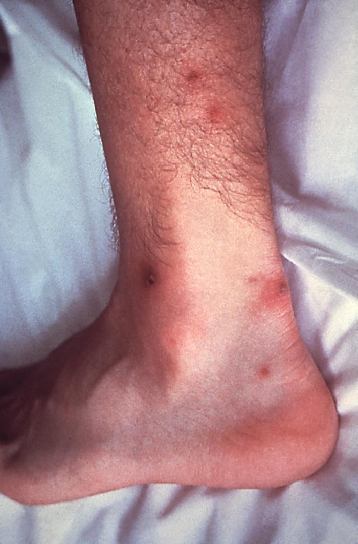 His patient presented with cutaneous lesions on his left ankle and calf due to a disseminated N. gonorrhoeae infection. Though sexually transmitted, and involving the urogenital tract initially, a Neisseria gonorrhoeae bacterial infection can become disseminated systemically, manifesting itself as a cutaneous erythematous lesion anywhere on the body.