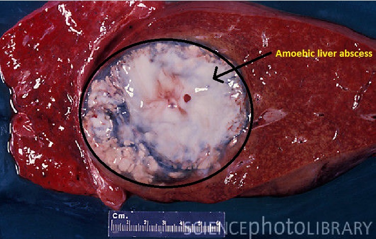 Amoebic liver abscess
