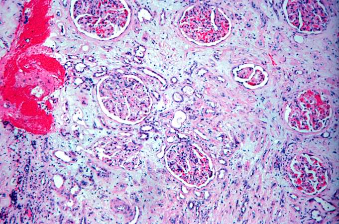 This is a photomicrograph of kidney with a focal area of hemorrhage around a small blood vessel (left) and congestion of the glomeruli. Note that there is a marked loss of renal tubules throughout this section with replacement by fibrous connective tissue. Also note the cellularity of the glomeruli.