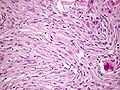 Fibrous meningioma with spindle cells in parallel bundles