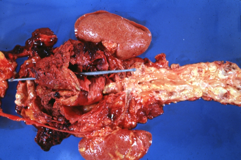 Abdominal Aneurysm Ruptured: Gross (good example) opened kidneys in marked place, atherosclerosis in lower thoracic aorta