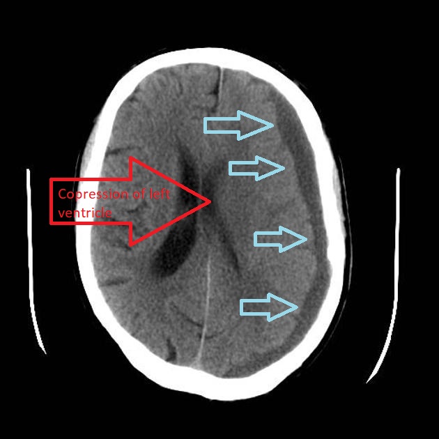 File:Chronic subdural CT.jpg