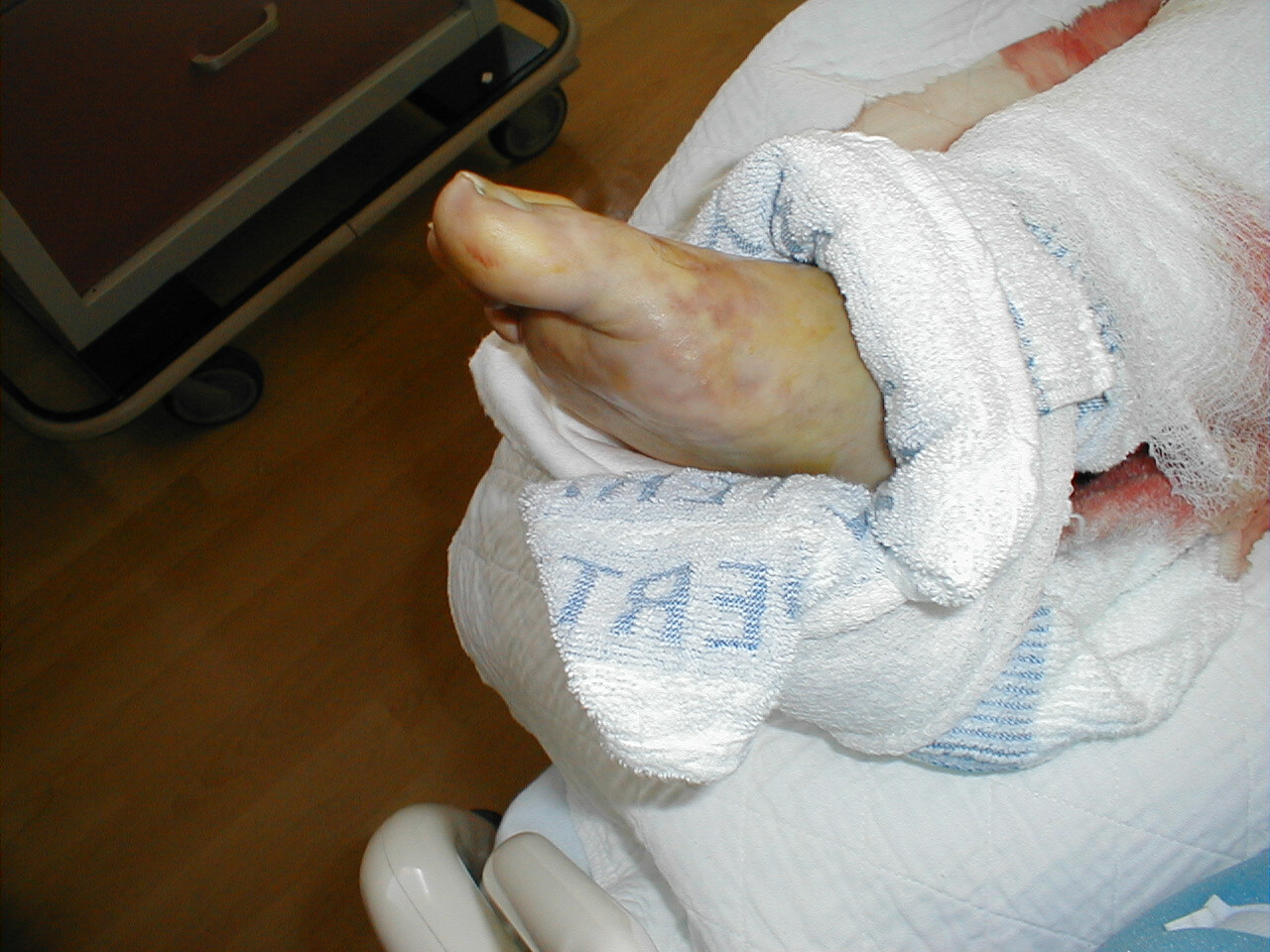 Acute Arterial Insufficiency: Embolus to right lower extremity resulted in acute vascular insufficiency to foot. Note mottled appearance. (Image courtesy of Charlie Goldberg, M.D., UCSD School of Medicine and VA Medical Center, San Diego, California)