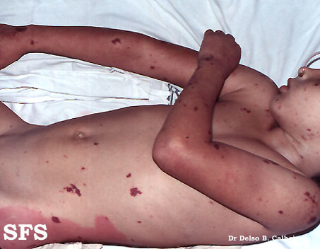 Meningitis. With permission from Dermatology Atlas.[1]