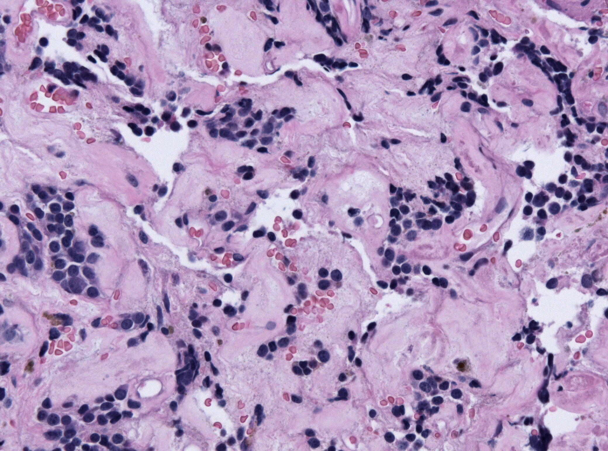 Pituitary adenoma of lactotroph cells (prolactin producing) regression after treatment - by Jensflorian source: Librepathology