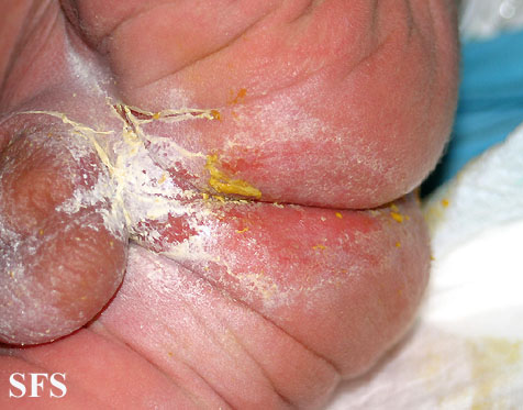 Acrodermatitis enteropathica. Adapted from Dermatology Atlas.[1]