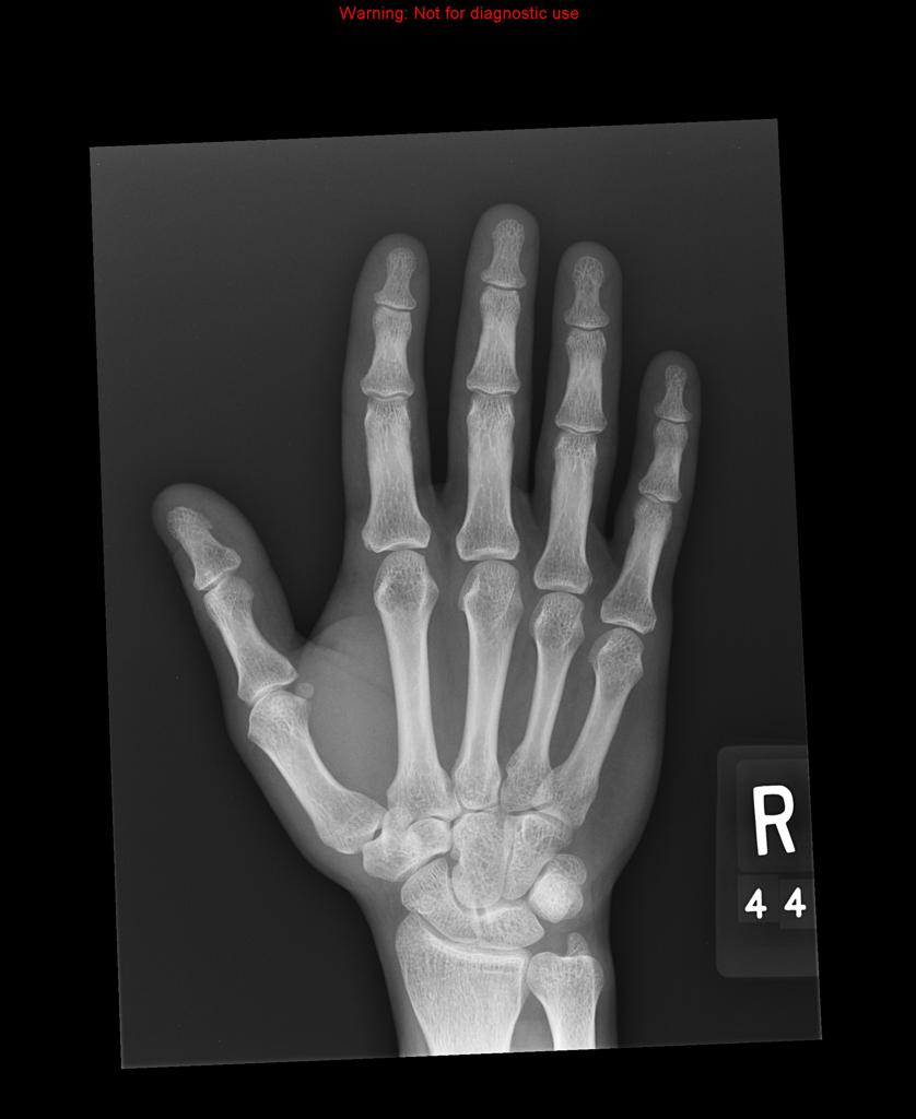 Small ship fracture noted at the ulnar aspect of the base of first phalanx.