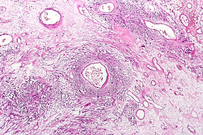File:Gastrointestinal stromal tumor (GIST).jpg
