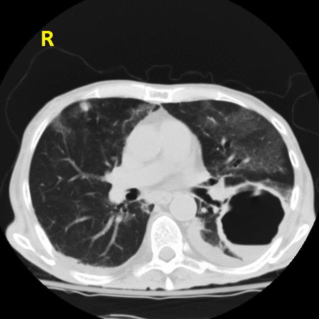File:Lung abscess CT1.gif.gif
