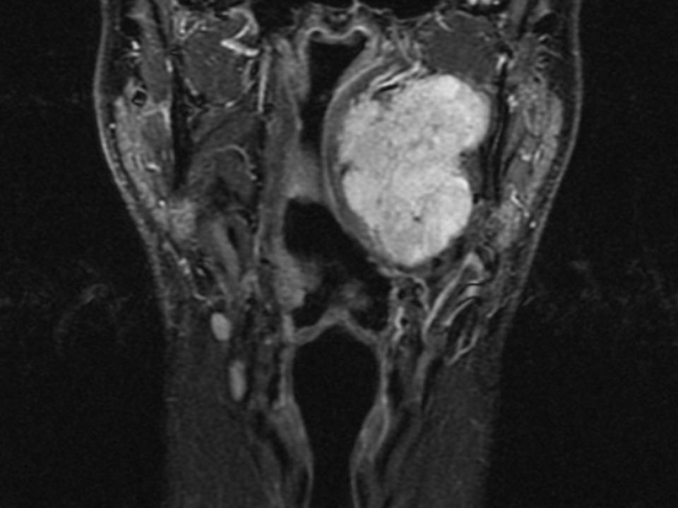File:Pleomorphic adenoma MRI.gif