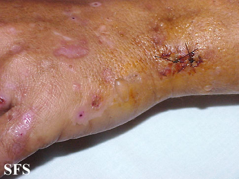 Porphyria cutanea tarda. With permission from Dermatology Atlas.[1]