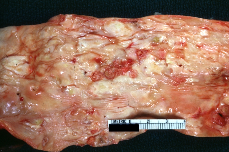Atherosclerosis: Gross, very good example of plaque lesion and small mural thrombi