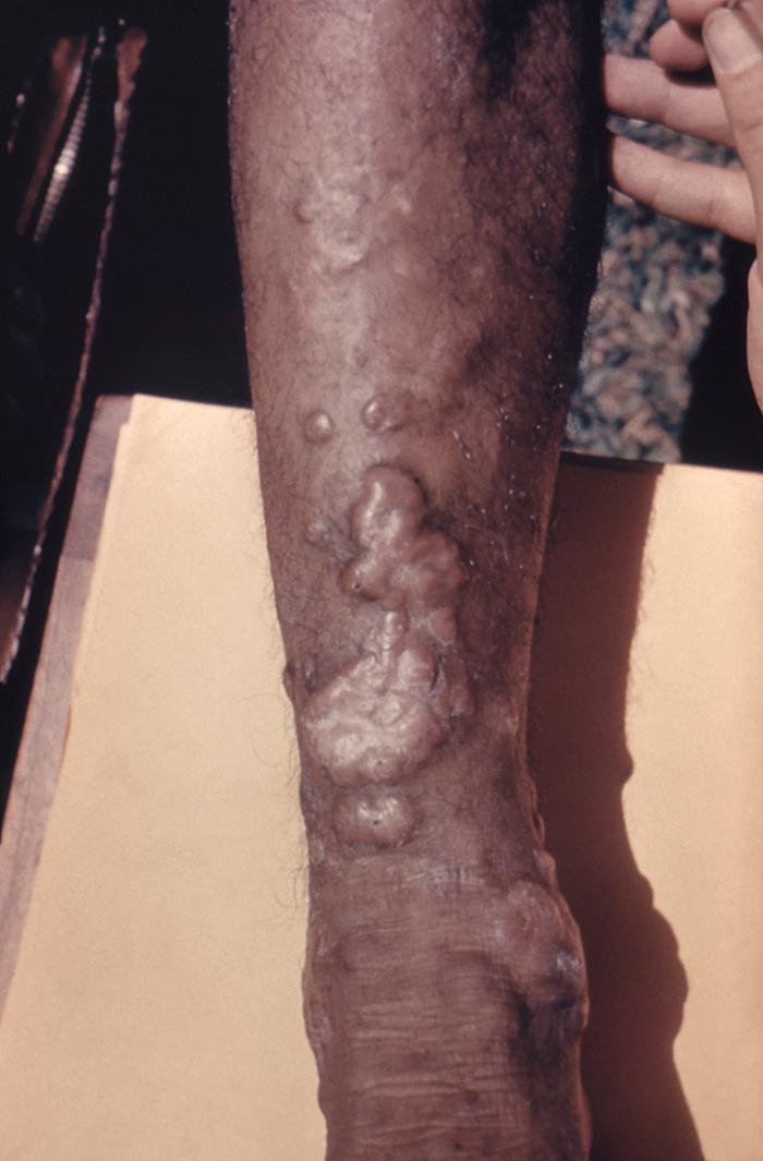 Morphologic changes that took place upon a patient’s arm, which included keloidal scarring brought on due to a case of cutaneous blastomycosis, caused by Blastomyces dermatitidis. From Public Health Image Library (PHIL). [26]