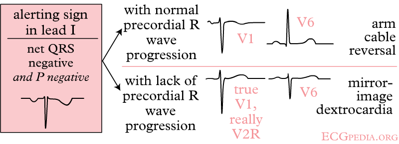 Right and left arm lead reversal can be distinguished from the (much rarer) dextrocardia by looking at the precordial R wave progression.