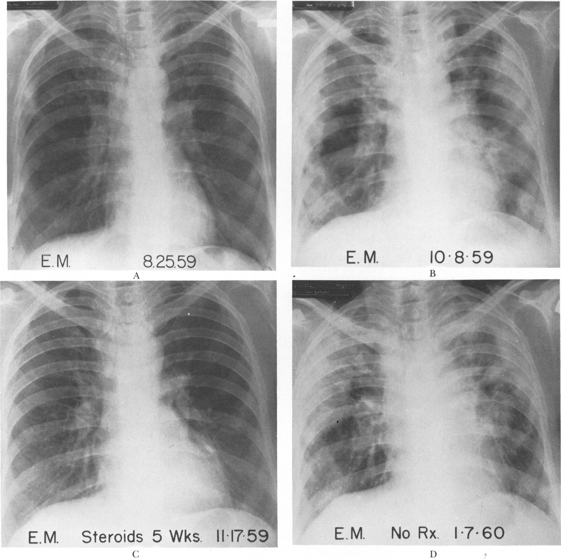 File:Esoniphilic pneumonia.jpg