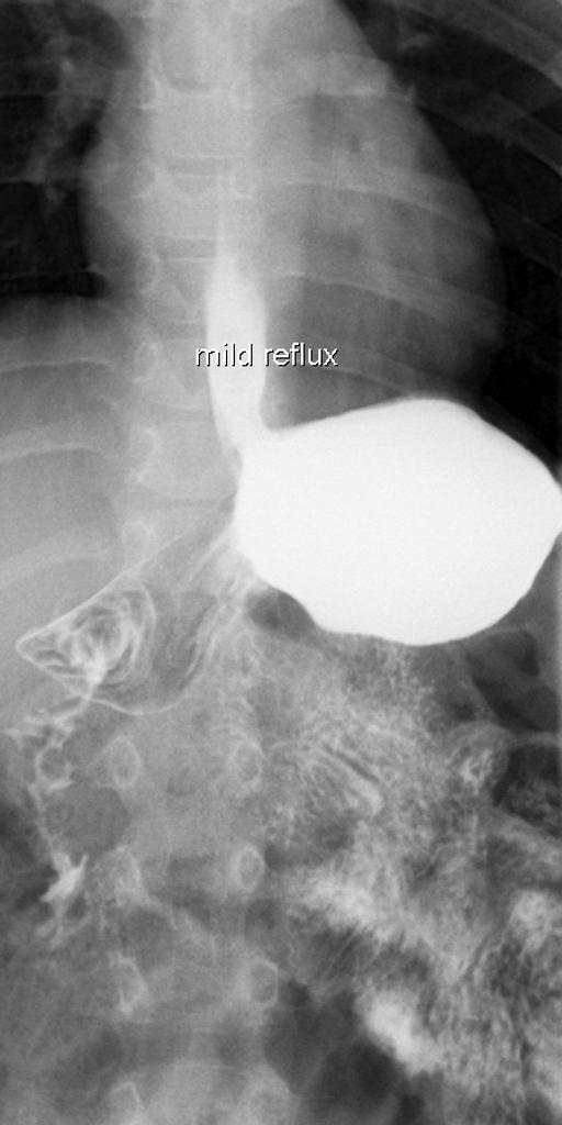 Esophagitis x ray - wikidoc