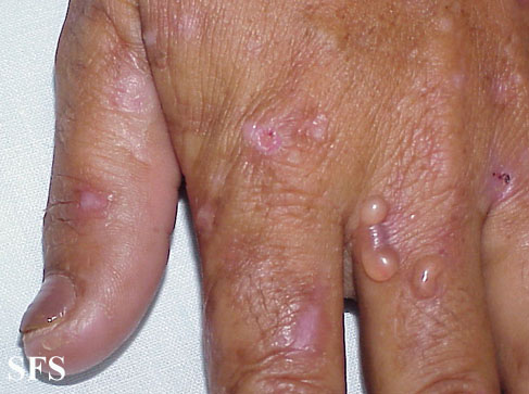 Porphyria cutanea tarda. With permission from Dermatology Atlas.[2]