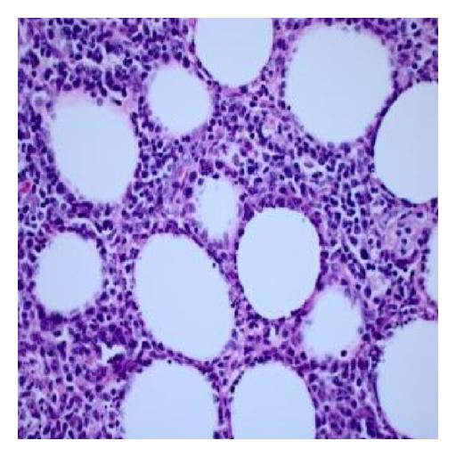 File:Subcutaneous panniculitis-like T-cell lymphoma biopsy 2.jpg