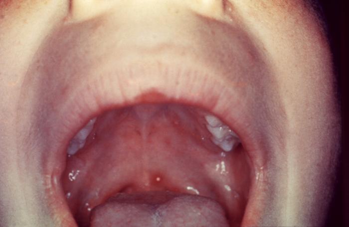 Patient developed palatal mucosal lesions due to chickenpox. From Public Health Image Library (PHIL). [1]