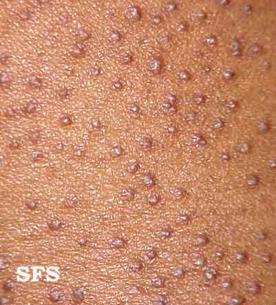 Keratosispilaris. Adapted from Dermatology Atlas.[1]