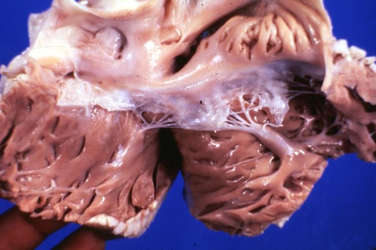 Tricuspid valve normal: Gross natural color (a good view) 18 year old African-American male died due to anomalous origin left coronary artery from right cusp