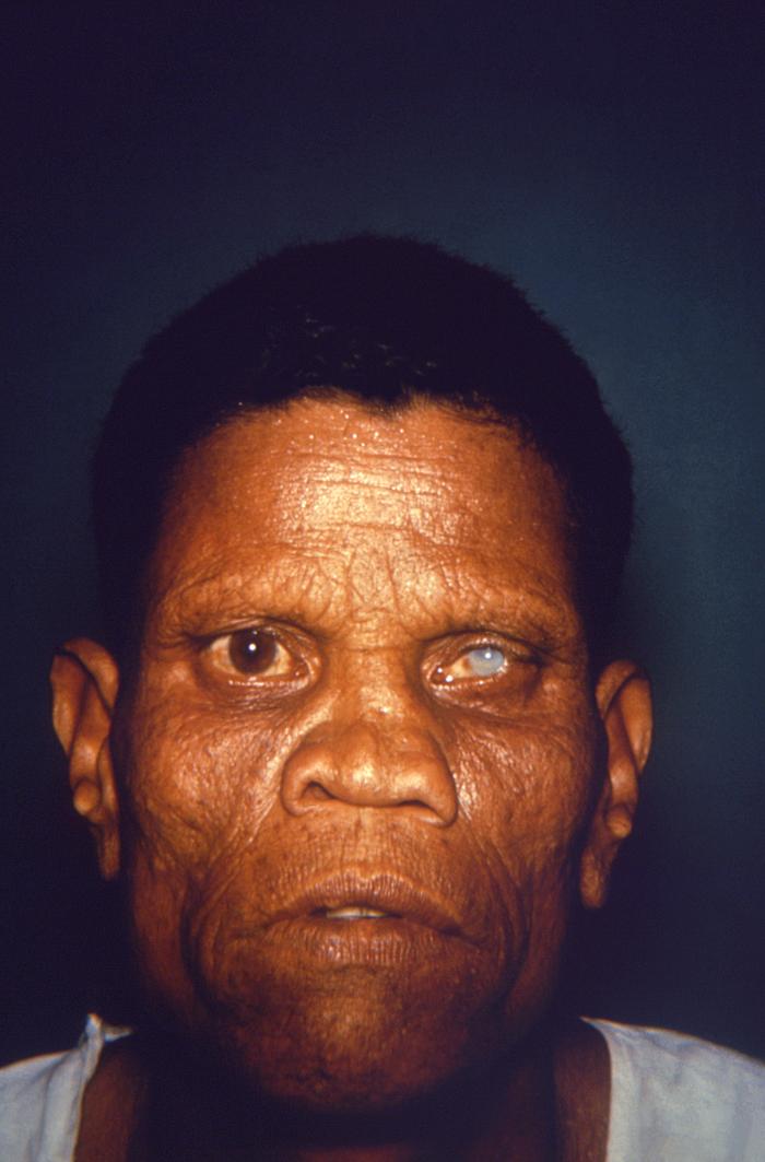 Lepromatous or multibacillary leprosy. Note wrinkling of the face, especially the midface involving nose and cheeks, and around the eyes. Adapted from Public Health Image Library (PHIL), Centers for Disease Control and Prevention.[6]