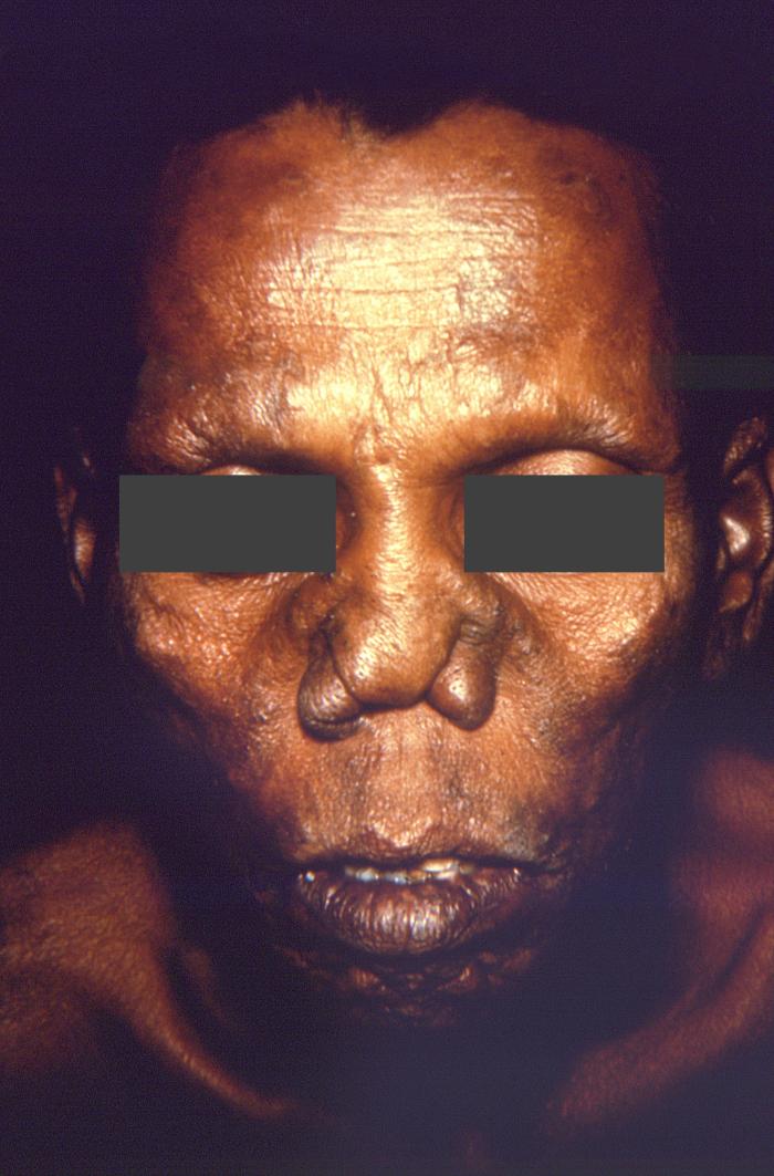 Complications of lepromatous or multibacillary leprosy. Note saddle-nose deformity following disintegration of nasal cartilage and lack of eyebrows. Adapted from Public Health Image Library (PHIL), Centers for Disease Control and Prevention.[6]