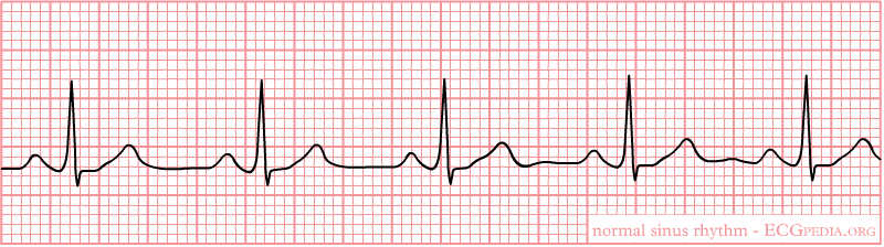 A short ECG recording of normal heart rhythm (sinus rhythm)]]
