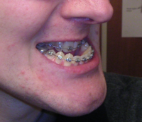 Example of prognathism, where teeth have almost reached their final, straight position by braces. This makes the prognatism more obvious, and it will take a surgery, moving the jaw backwards, to give the ultimate result.