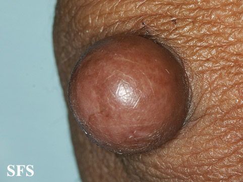 Proliferating trichilemmal cyst. With permission from Dermatology Atlas.[3]