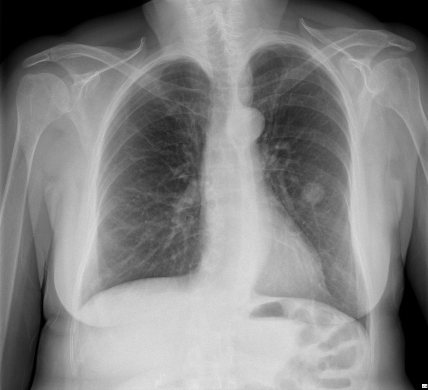 Frontal chest x-ray (CXR) shows a well circumscribed, smooth margin lesion in the left middle lobe.