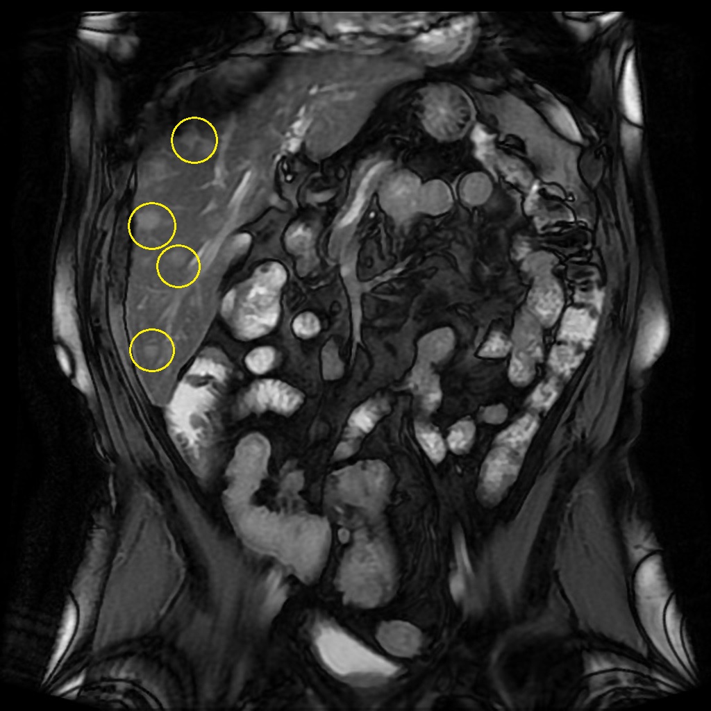 File:Small-bowel-carcinoid-with-liver-metastases.jpg