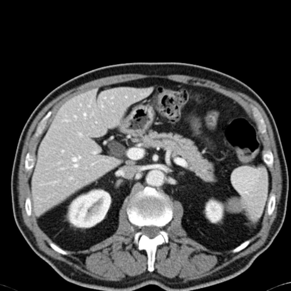 CT scan (CT) shows an isodense solid mass in the inferior pole of the spleen.