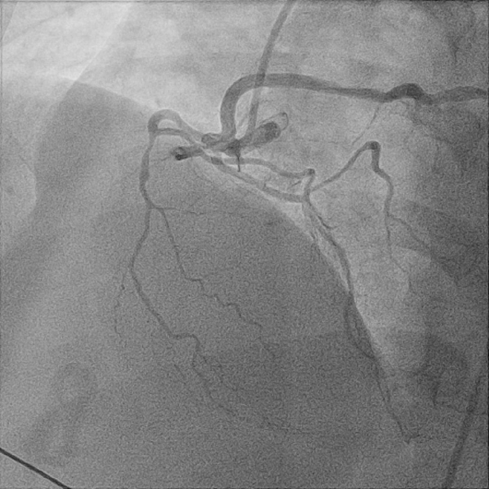 Figure 3. Left anterior oblique cineangiography of selective coronary injection of the right coronary (RCA). LCx (left circumflex coronary artery); LAD (left anterior descending coronary artery)