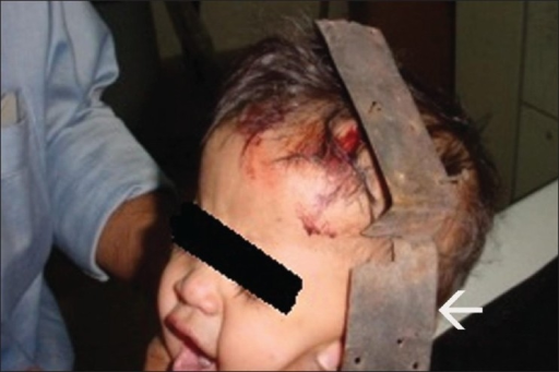 File:Child with impacted metal strip (white arrow)..png