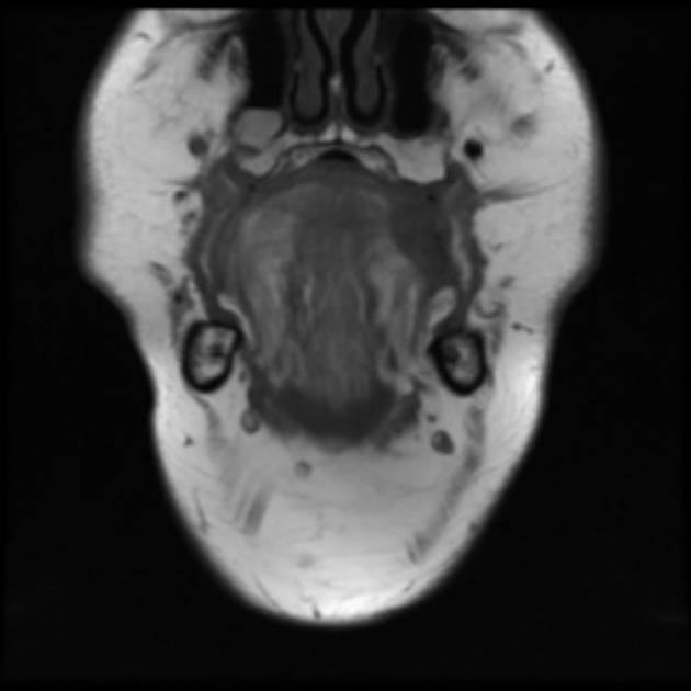 Coronal T1 MRI of squamous cell carcinoma of tongue [2]