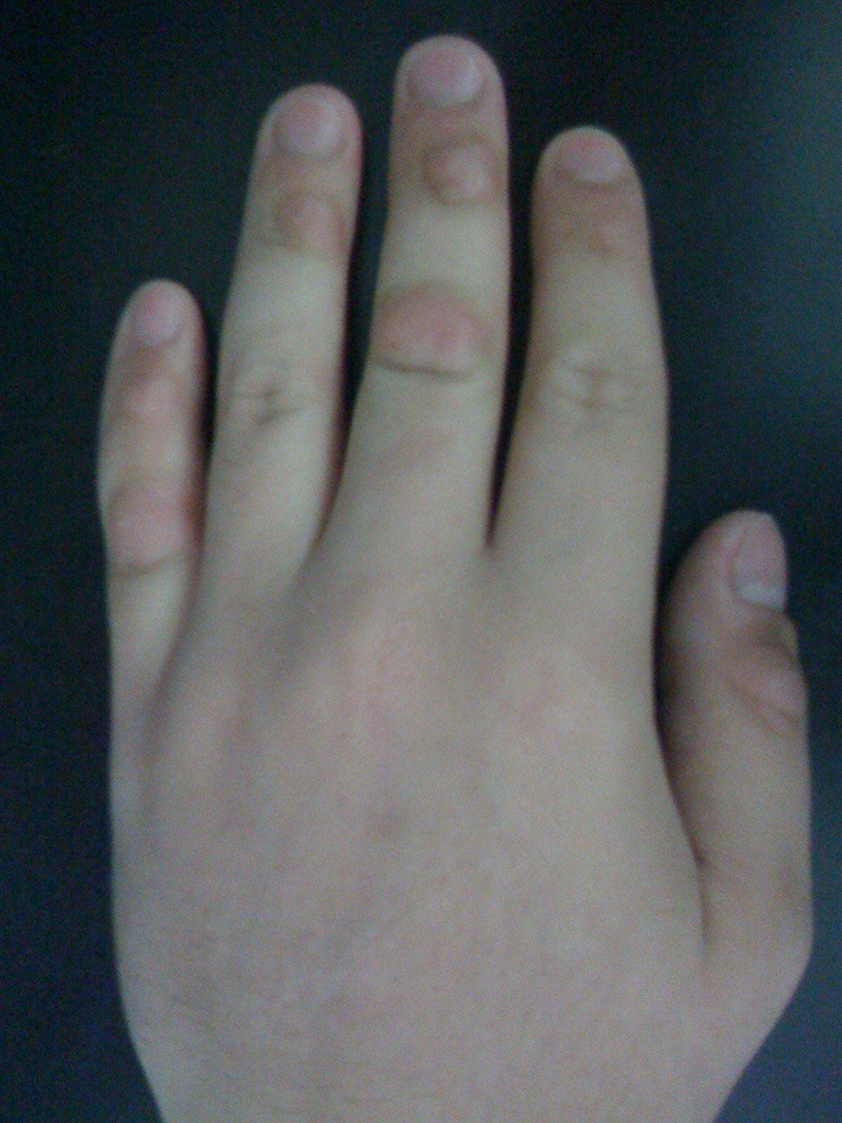 File:Dermatillomania fingers.JPG