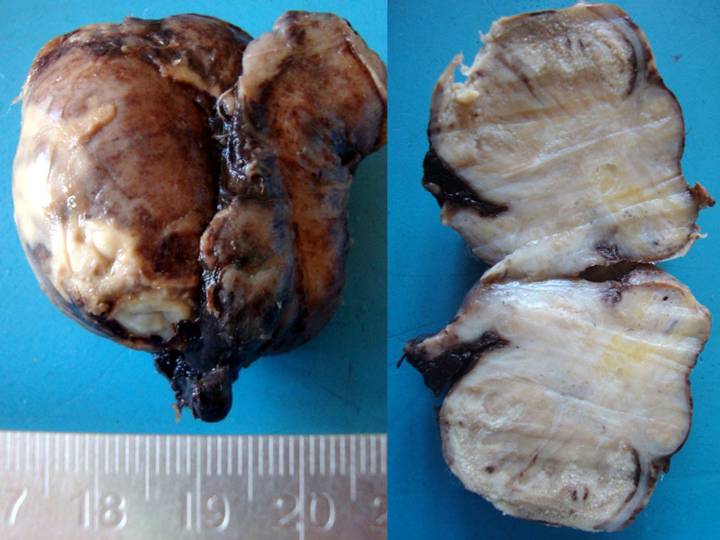 Image on the left shows evidence of acute inflammation and exudates on the surface of the testicle. Image to the right is a cut section showing exudates and dense fibrosis in the epididymis. Adapted from https://commons.wikimedia.org/wiki/Category:Gross_pathology_of_epididymo-orchitis#/media/File:Acute_epidydimoorchitis_Gross_Pathology.jpg. Accessed on Jan 3rd, 2017.