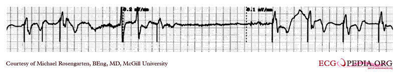 Pacemaker sensitivity.jpg