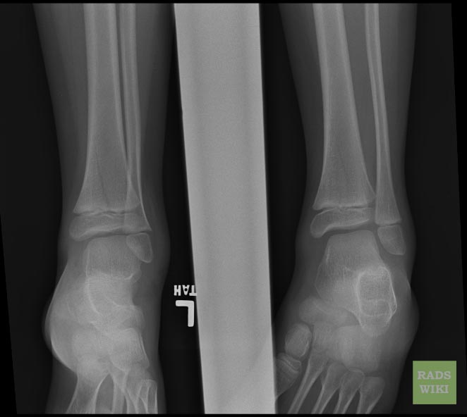Salter-Harris fracture-II Image courtesy of RadsWiki and copylefted