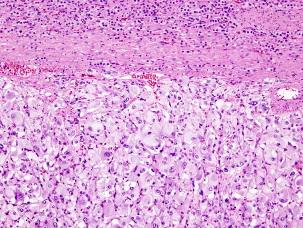 Micrograph of pheochromocytoma, source: By Nephron - Own work, CC BY-SA 3.0, https://commons.wikimedia.org/w/index.php?curid=5938524