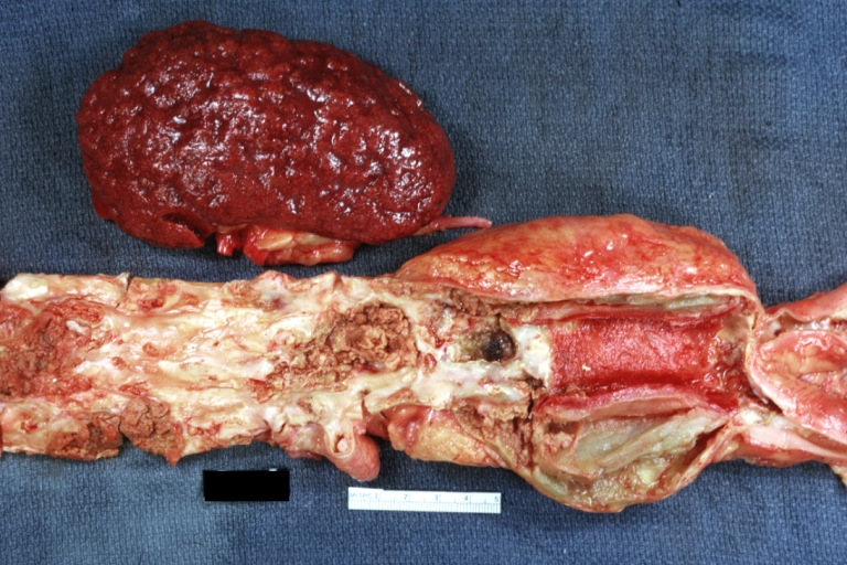 Kidney: Arteriosclerosis: Gross aorta with well shown renal artery containing large plaque and kidney with multiple cortical scars and atrophy also abdominal aorta aneurysm with mural thrombus (excellent example for renovascular hypertension)