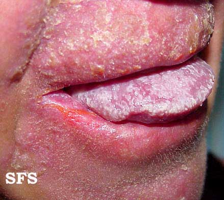 Candidiasis chronic mucocutaneos. Adapted from Dermatology Atlas.[4]</SMALL