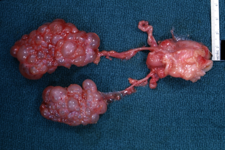 Infantile polycystic disease: Gross natural color view of both kidneys with ureters and uterus (very good example)